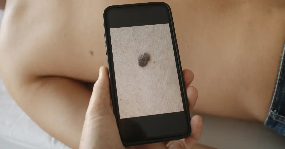 La télédermatologie mise en lumière